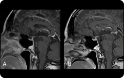 MRI 1.5T com AIR™ Recon DL fornecendo qualidade de imagem e tempos de aquisição semelhantes aos da MRI 3T