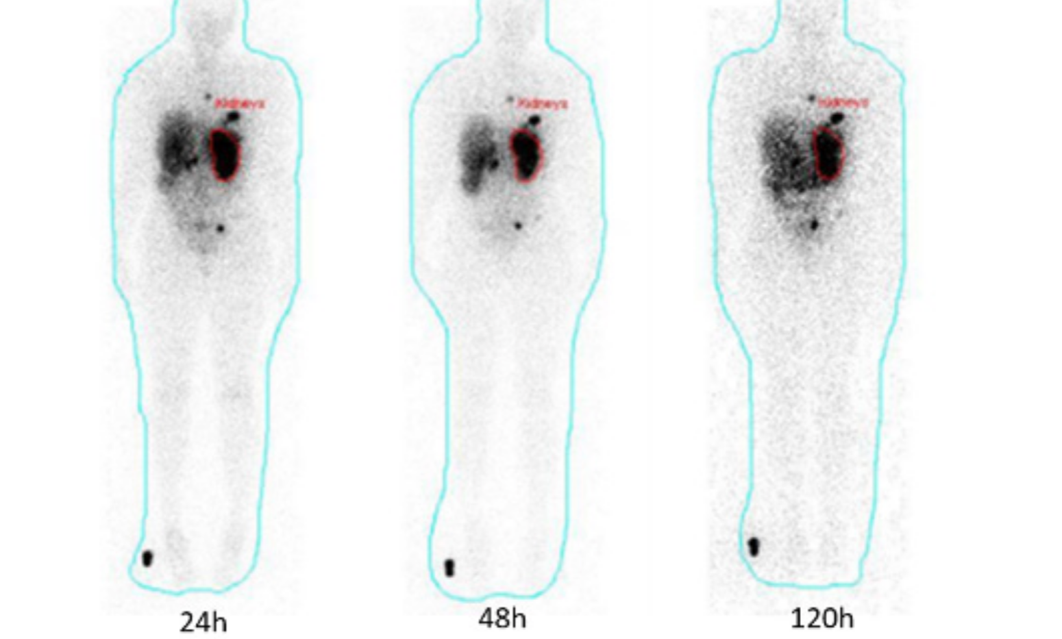 Avaliação de funções Renais usando Dosimetry Toolkit para tratamento de um tumor neuroendócrino metastático de um paciente com um único rim