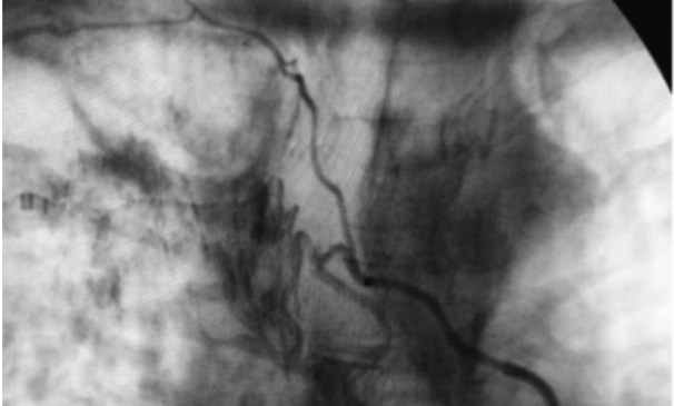 Técnica Angiográfica de Urgencia con OEC ONE Vascular