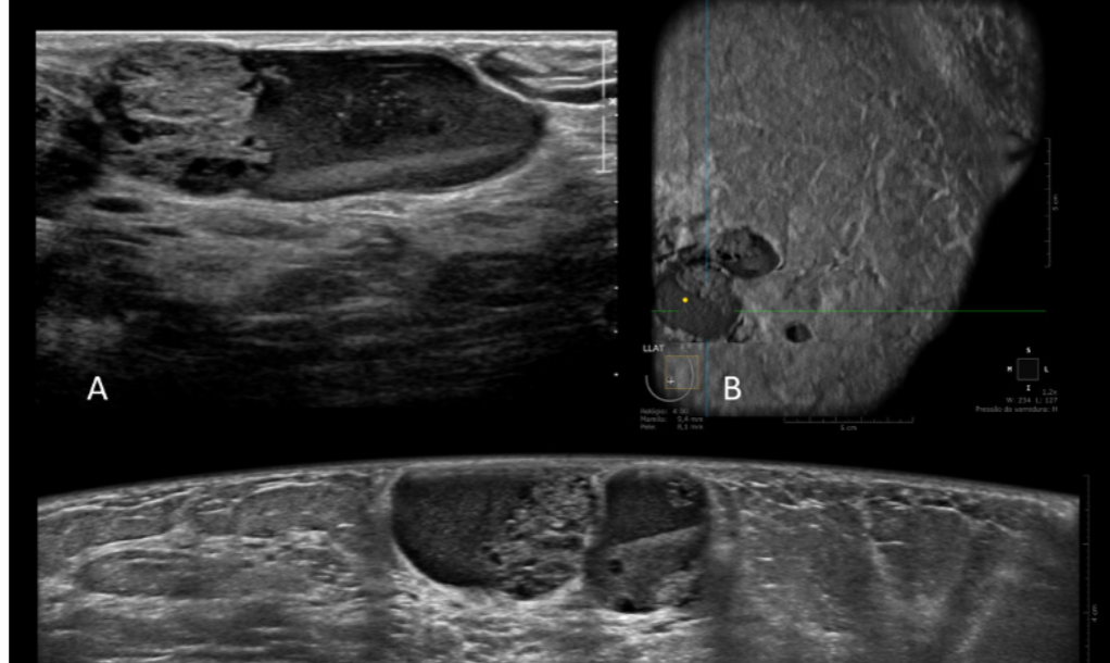 Automated Breast Ultrasound (ABUS): uma tecnologia inovadora e diferenciado na avaliação de mamas densas no rastreamento de câncer