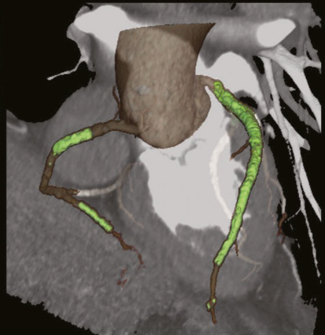 Advanced High-Resolution CT Approaches for Coronary Stent and Calcified Plaque Assessment