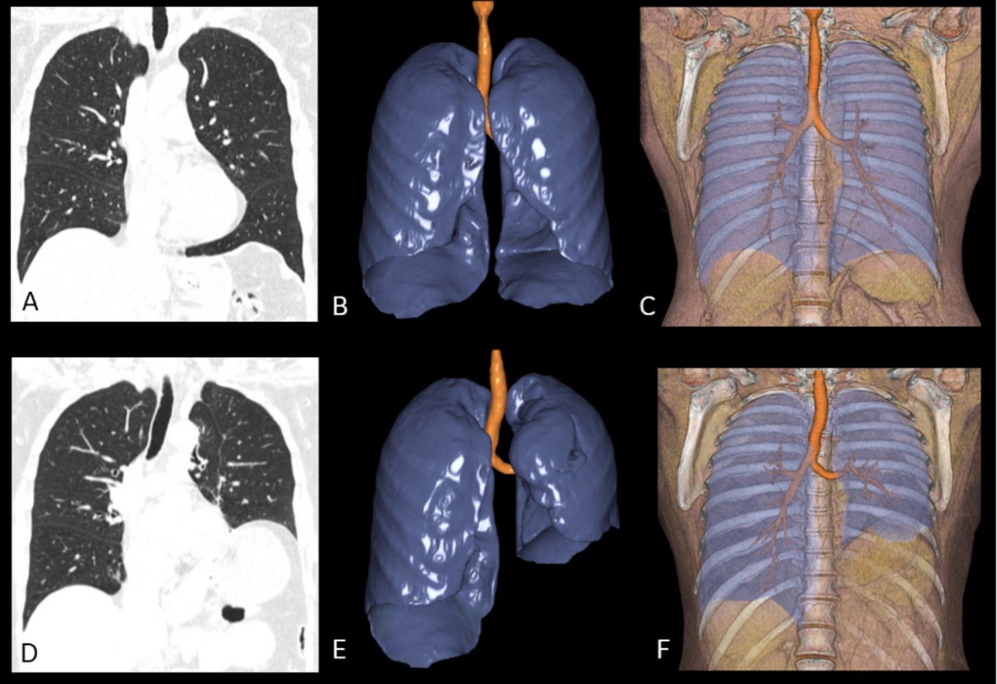 Dynamic Assessment of Diaphragmatic Paralysis with Low-Dose CT and Dynamic Shuttle Acquisition with Volume Helical Shuttle Technique
