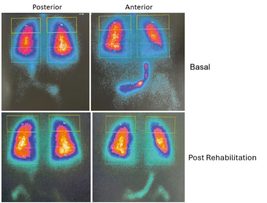 Importance of V/Q Scintigraphy in the Diagnosis and Monitoring of Post-COVID-19