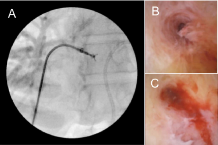 Advanced Hepatobiliary Intervention in  an Outpatient Setting: Expanding Access  to High-Complexity Care with OEC 3D